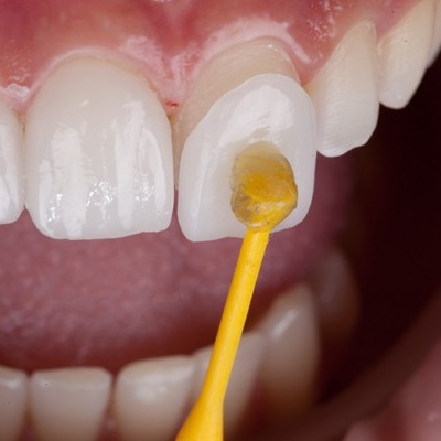 A porcelain veneer being placed on a front tooth