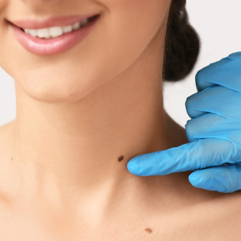 A gloved clinician pointing to a mole on a smiling woman’s neck