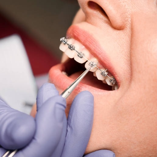 A dentist checking fixed braces with a dental instrument